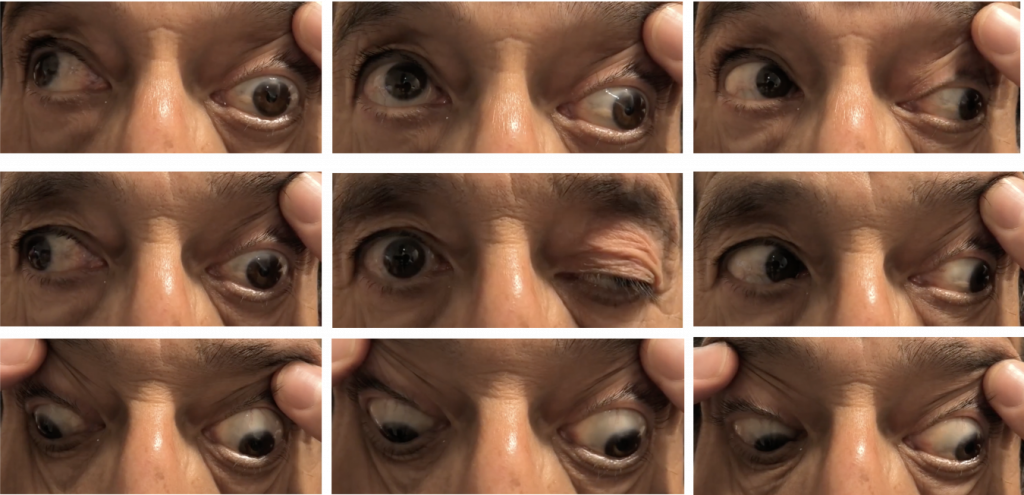 Left CN III Palsy